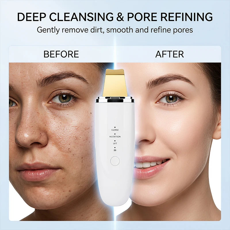 LESEN Skin Care Ultrasonic Skin Scrubber Blackheads Whiteheads Exfoliator Vibrating Facial Scraper Pore DeepCleanser Face Lifter
