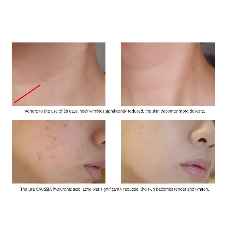 ARTISCARE Hyaluron Acid Serum 10pcs/Lot for Face Moisturizing and Hydrating Anti Aging Skin Care Essence Facial Care