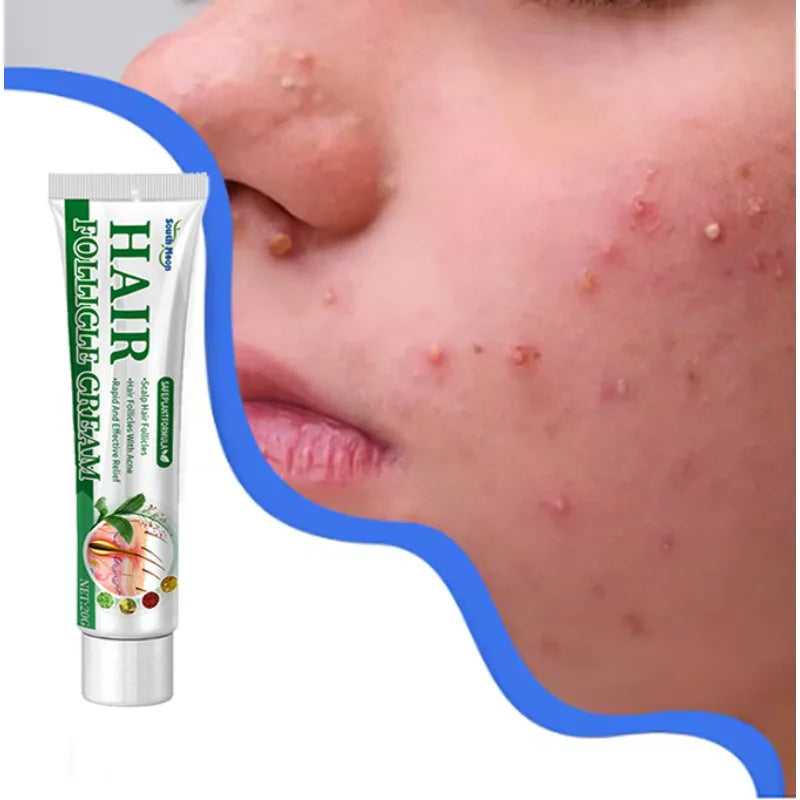 7day Acne Removal Comfortable Acne-removing Liquid Improve Acne Convenient Facial Repair Solution Skin Care Products Gentle