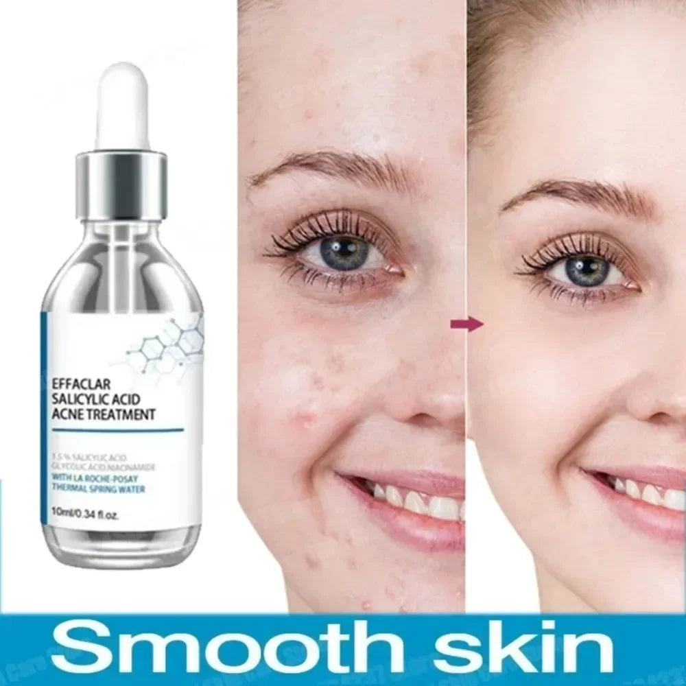 Face Serum Fruit Acid Acne Treatment Oil Control Remove Blackheads Shrink Pores Skin Texture Improve Care