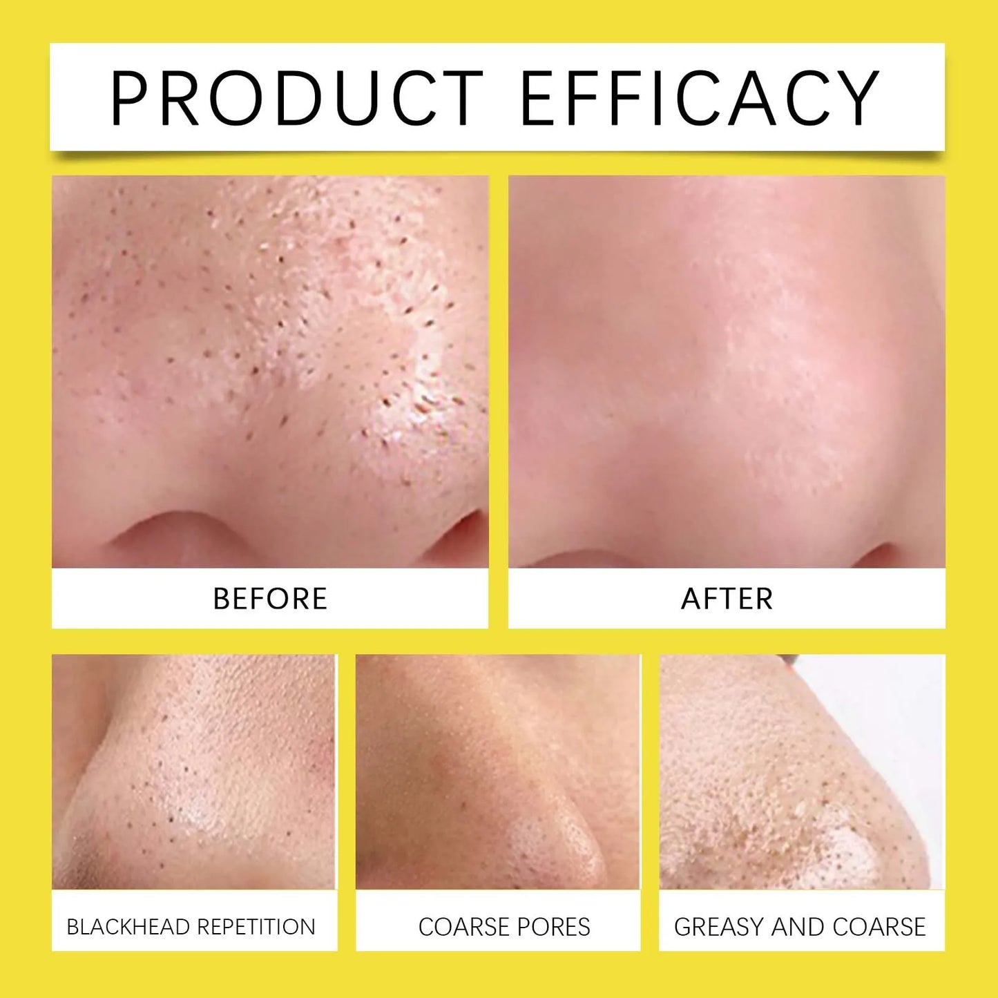 HOYGI 12-60PCS Hydrocolloid Nose Patches Blackhead Removal Nose Patch Deep Cleansing Pimples Pores Shrinking Skin Care Mask