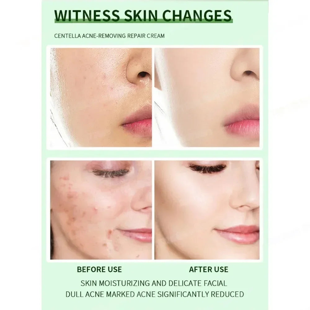 7day Acne Removal Comfortable Acne-removing Liquid Improve Acne Convenient Facial Repair Solution Skin Care Products Gentle