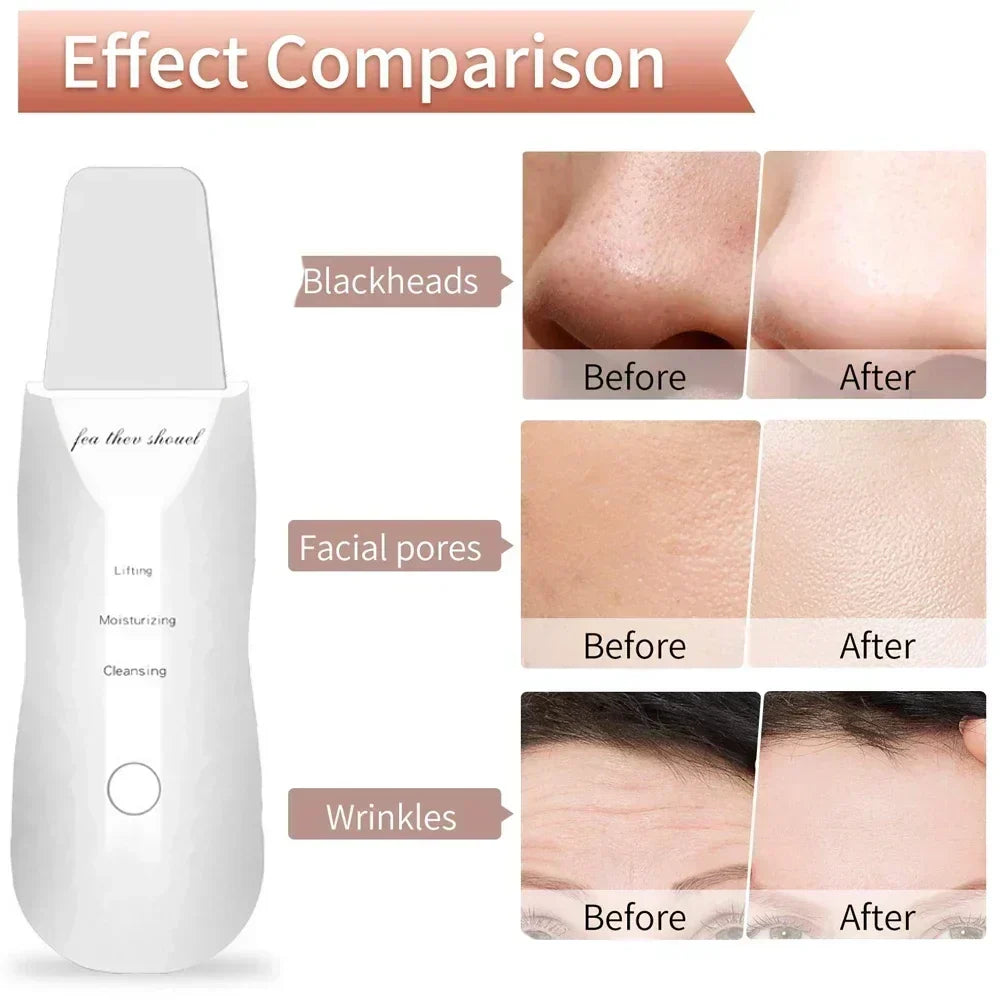 Electric Facial Pore Cleansing Spatula