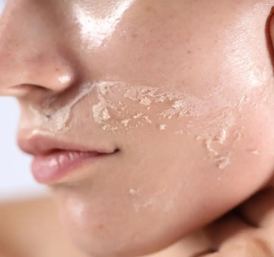Dilute melanin, acne, 50% TCA, high-quality chemical exfoliation, acidic skin beauty care