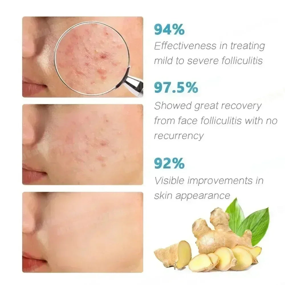 7day Acne Removal Comfortable Acne-removing Liquid Improve Acne Convenient Facial Repair Solution Skin Care Products Gentle