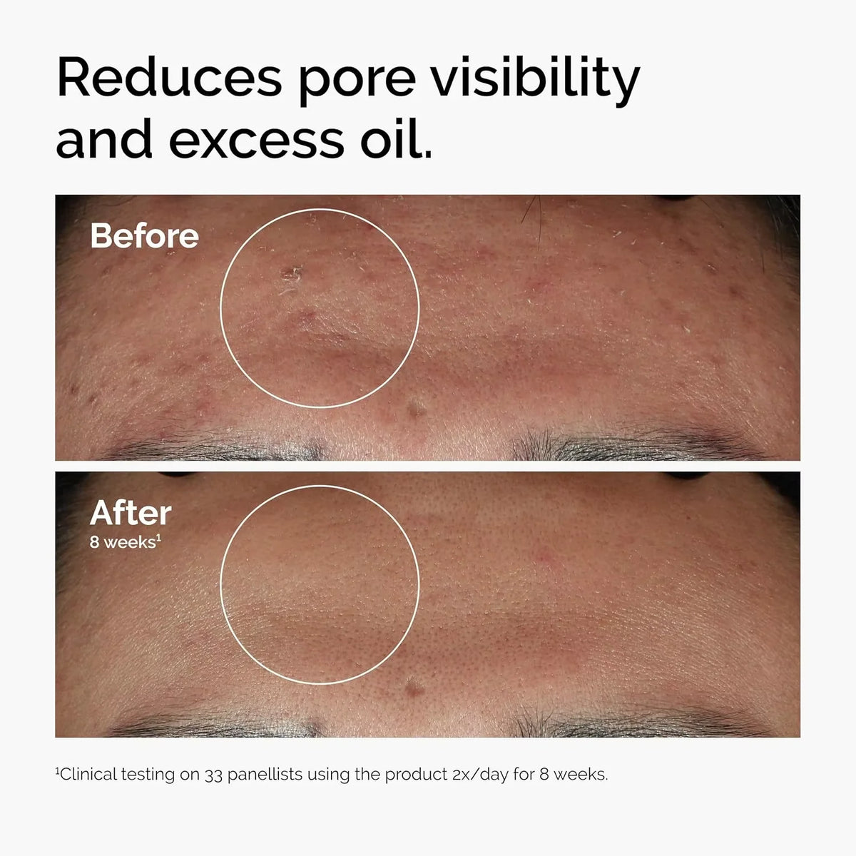 10% Niacinamide 1% Zinc Facial Serum 30ml Gentle Oil Balance Pore Refining Hydrating Smoothing Skin Care For All Skin Types
