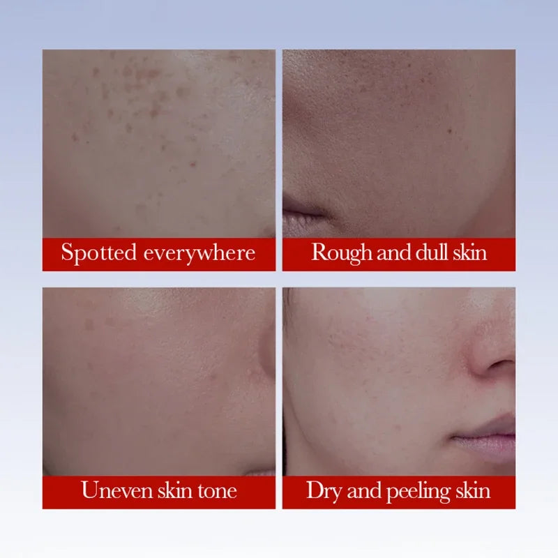 SADOER Anti Freckle Cream Face Whitening Creams Spot Removing Anti-aging Moisturizing Freckles Removal Facial Cream Skin Care