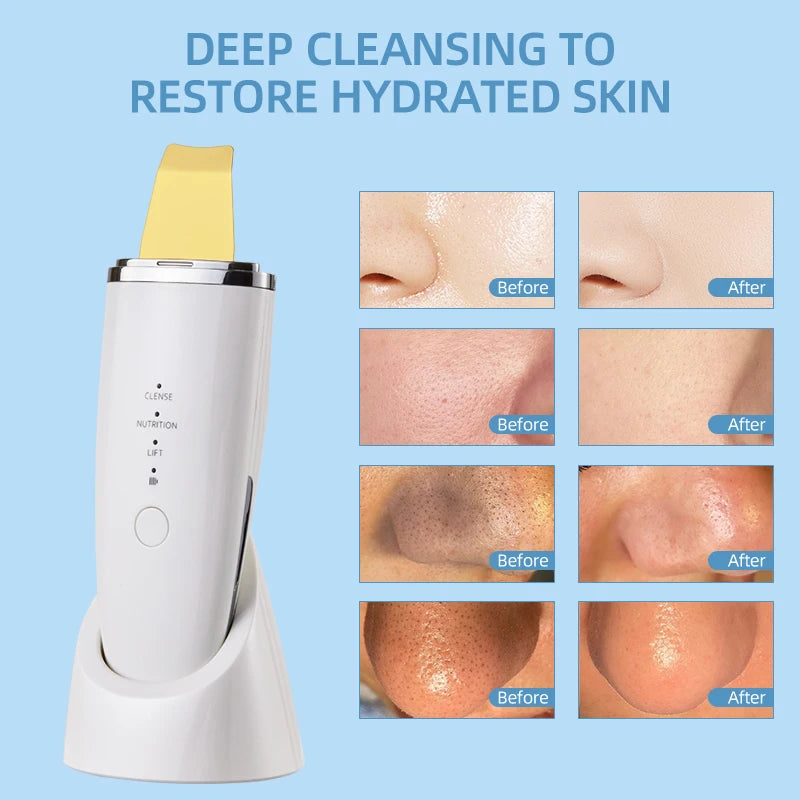 LESEN Skin Care Ultrasonic Skin Scrubber Blackheads Whiteheads Exfoliator Vibrating Facial Scraper Pore DeepCleanser Face Lifter
