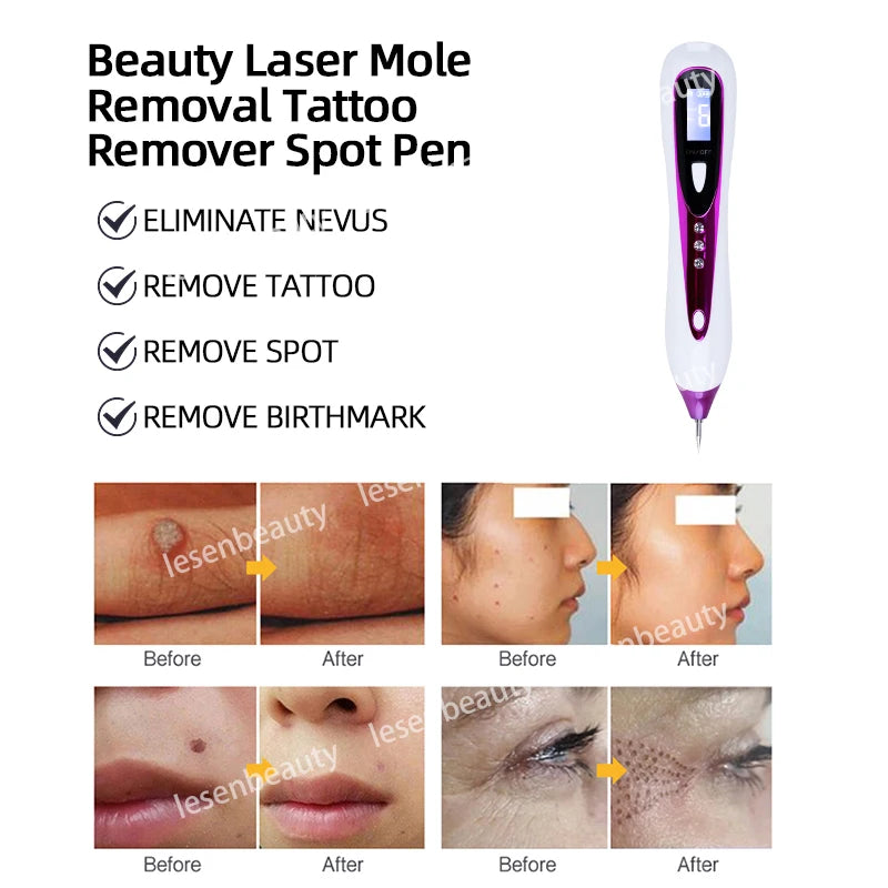 NEW Plasma Pen Mole Removal Pen Sweep Spot Wart Corn Dark Remover LCD Professional 9 Speed Skin Care Salon Beauty Tool LESEN